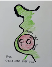 International Day to End Obstetric Fistula